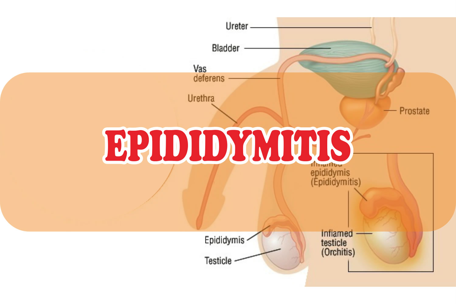  - Top 5 Epididymitis natural treatment providers 2023